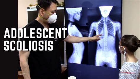 Adolescent Non Surgical Scoliosis Treatment By Dr Suh Gonstead