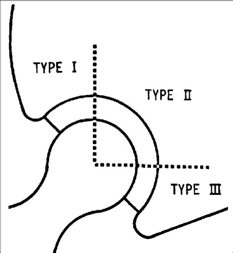 Division Of Circumference Of Acetabular Bone Cement Interface In Zones