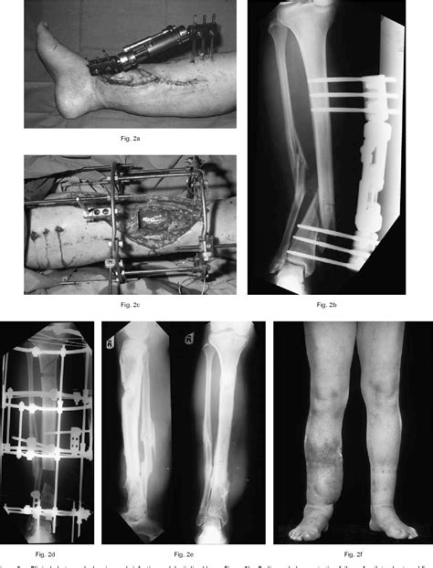 Figure 2 From Management Of Severe Open Tibial Fractures The Need For