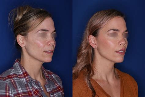 🥇 atlanta facial cosmetic surgery before and after photos benjamin c stong md