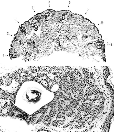 Multiple Hereditary Infundibulocystic Basal Cell Carcinomas A