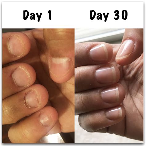 How To Stop Biting Nails Angelas Results Nail Care Hq