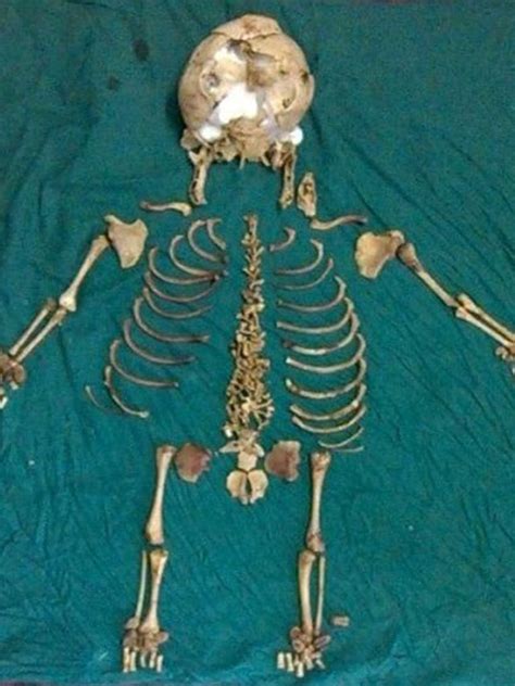 36 Year Old Skeleton Of Dead Baby Found Inside Indian Woman The