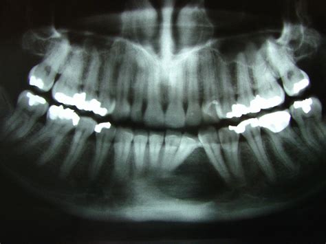 Oral Pathology and Jaw Cysts – Dentofacial