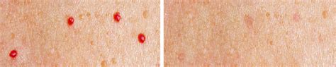 Blood Spot Removal Services Renew Skin Clinic