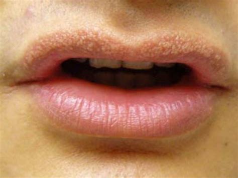 Bumps On Lips Causes Types Symptoms Treatment Prevention More