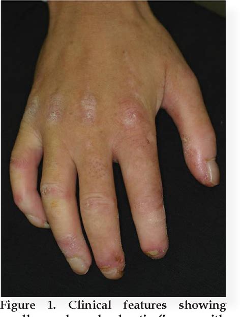 Figure 1 From Cutaneous Myxoid Cyst On The Sclerotic Finger In A