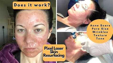 pixel laser treatment for acne scars and big pores youtube