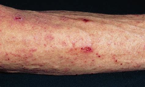 Prospective Study Of Scabies Outbreaks In Ten Care Homes For Older People