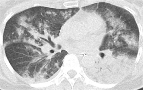 Non Cardiogenic Pulmonary Oedema Caused By Iodine Contrast Medium Bmj