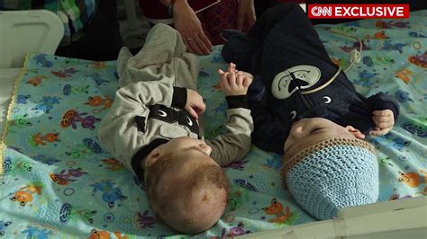 Successfully Separated Conjoined Twins Jadon And Anias Mcdonald Getting Stronger Every Day