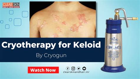 Cryo Therapy For Keloid Scar Keloid Scars Removal Treatment Drn