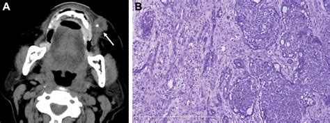 Myoepithelial Carcinoma Of The Salivary Gland Pathologic And Ct