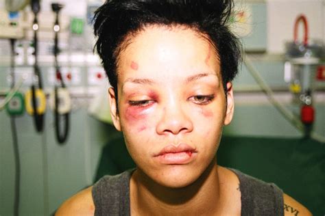 Photo Of Beaten And Bruised Rihanna Leaked To Web As Lapd Continues