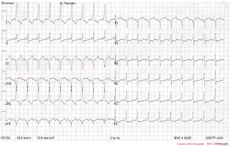 Tachycardia generally goes away when the underlying cause is treated appropriately. Wide complex tachycardia overview - wikidoc