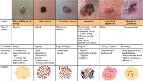 How To Describe Squamous Cell Carcinoma
