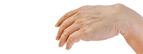 Do You Have A Ganglion Cyst Orthopedic And Sports Medicine