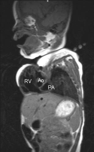 Complete Ectopia Cordis Circulation