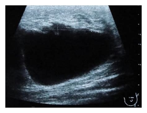Ultrasound Of The Left Breast 2nd Evaluation Cyst Measuring 44 Mm