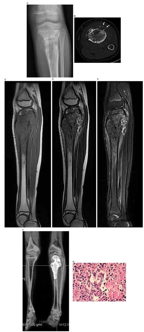 Osteosarcoma In A Female Patient Aged 10 Years Osteosarcoma Of Left