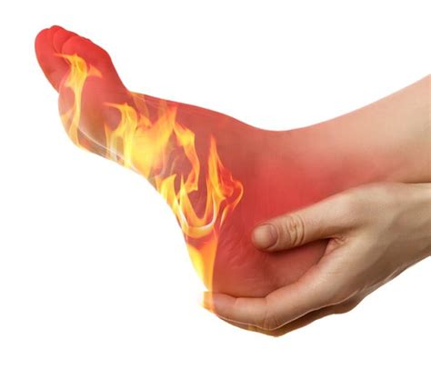 Natural Cures For Burning Feet Home Remedy And Natural Cures