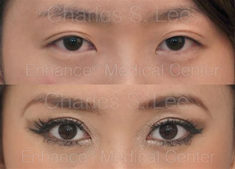 Eyelid Surgery Asian Eyelid Surgery Enhance® Medical Center Beverly Hills Ca