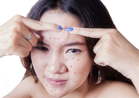 Why You Should Never Pop Pimples 4 Key Reasons Blog