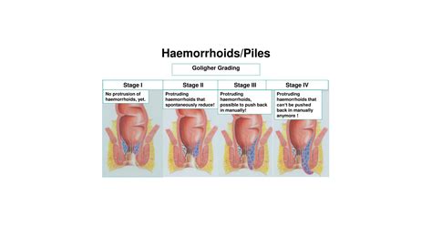 Haemorrhoids With Dr Thomas Suhardja Atticus Health