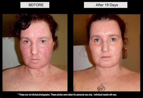 Eczema Before And After Click For Revitol Eczema Cream Revitol
