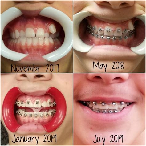 This includes the period during which you wear your braces, the active period, and the period of stabilizing the work done. The Definitive Guide for How Long Do Braces Last | Brace ...