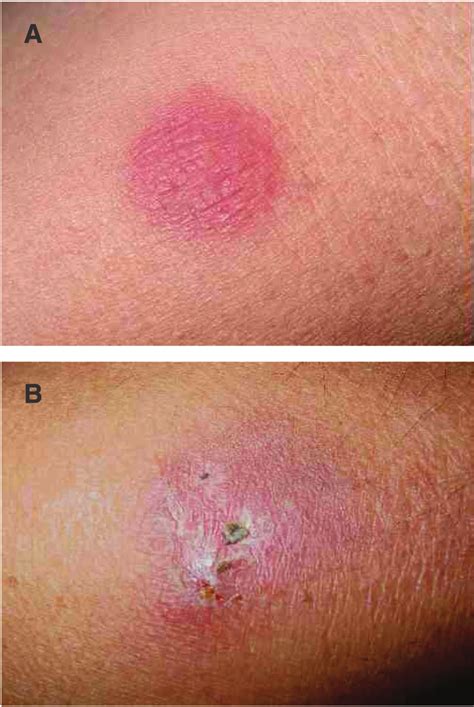 Erythema Induratum Of Bazin Nodular Vasculitis Erythematous Nodules