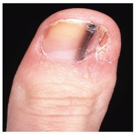 Squamous Cell Carcinoma Finger