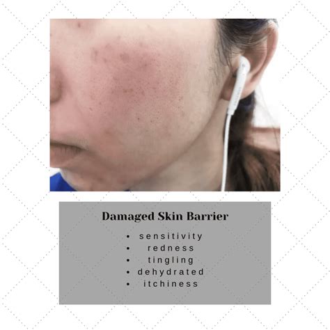 How To Repair A Damaged Skin Barrier Dry Skin Advice