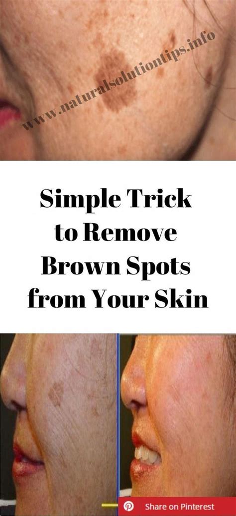 How You Can Take Away Brown Spots On Face Smallbrownspotsonface Raisedbrownspotsonface Brown