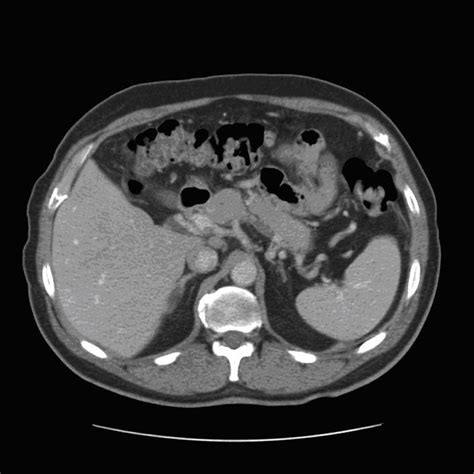 Abdominal Ct Scan Showing Splenic Vein Thrombosis L Liver S Spleen My