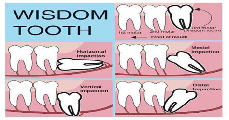 When Should Wisdom Teeth Be Removed