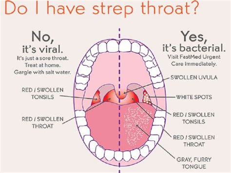 Cancer can develop in almost any tissue or organ of the body such as the throat, lung, colon, breast, skin, bones or nerve tissue. What-does-Strep-Throat-Look-Like | Sinus | Pinterest ...