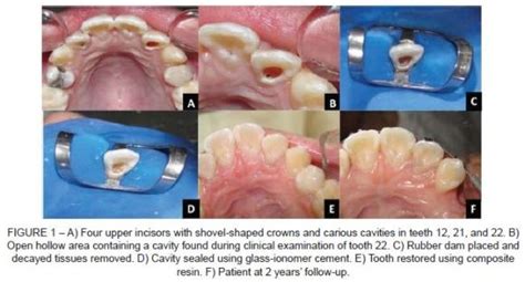 Stomatos Conservative Treatment Of Shovel Shaped Upper Incisors And