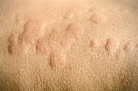 Hives Diagnosis And Treatment Oak Brook Allergists