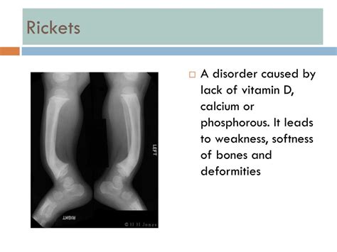 Ppt Rickets Ostemalancia Powerpoint Presentation Free Download