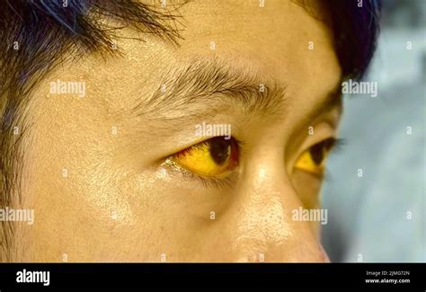 Liver Disease Yellow Eyes Skin Hi Res Stock Photography And Images Alamy