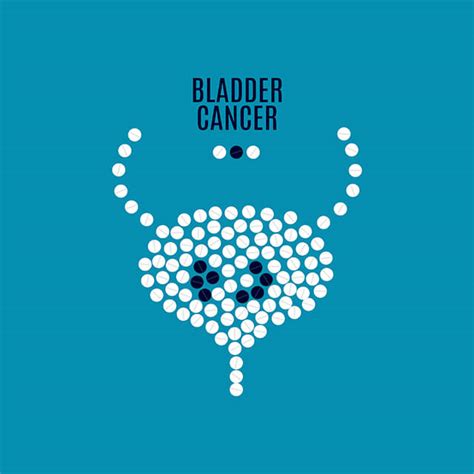 Bladder Cancer Manchester Urology Associates Pa