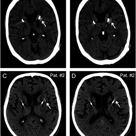 Intracerebral Hemorrhages In The Striatum Along Implanted Electrodes