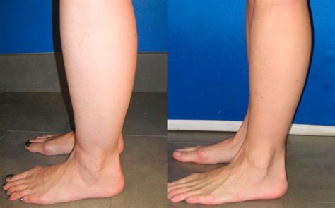 Leg Liposuction Atlanta Atlanta Liposuction Specialty Clinic