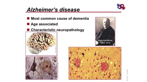 Wsdm Sex Differences In Alzheimer S Disease Youtube
