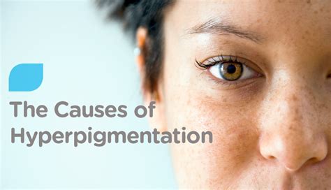 Hyperpigmentation What Causes It And How To Get Rid Of It Watsons