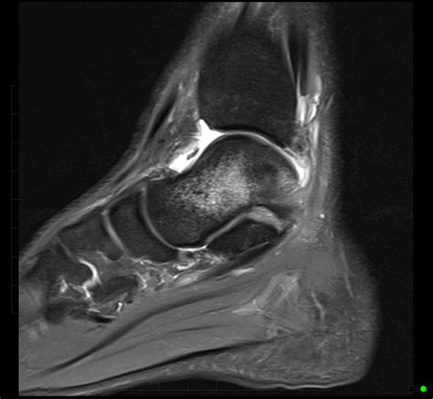 Mri Ankle Anterior Talofibular Ligament Rupture 2 Mri At Melbourne