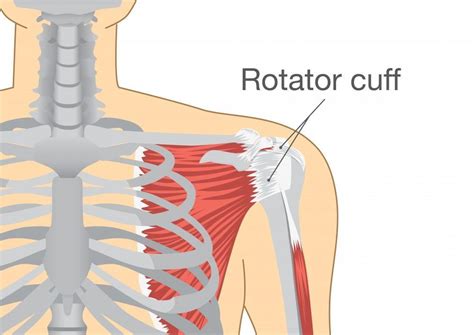 5 Symptoms Of A Rotator Cuff Tear Restoration Orthopedics Orthopedic
