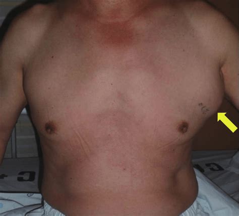A Preoperative Photograph Shows A Huge Mass In The Left Axilla