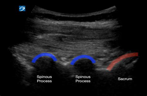 Ultrasound Guided Lumbar Puncture St Josephs Health Center